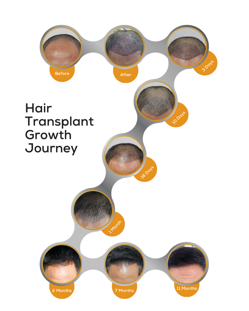 Hair Transplant Growth Journey Hair Transplant Growth Journey
