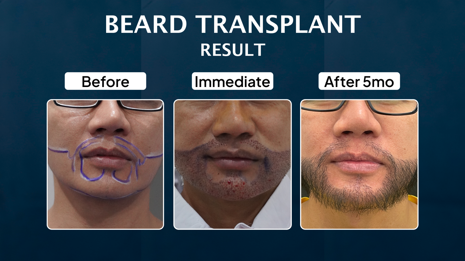 Journey Beard 5mth
