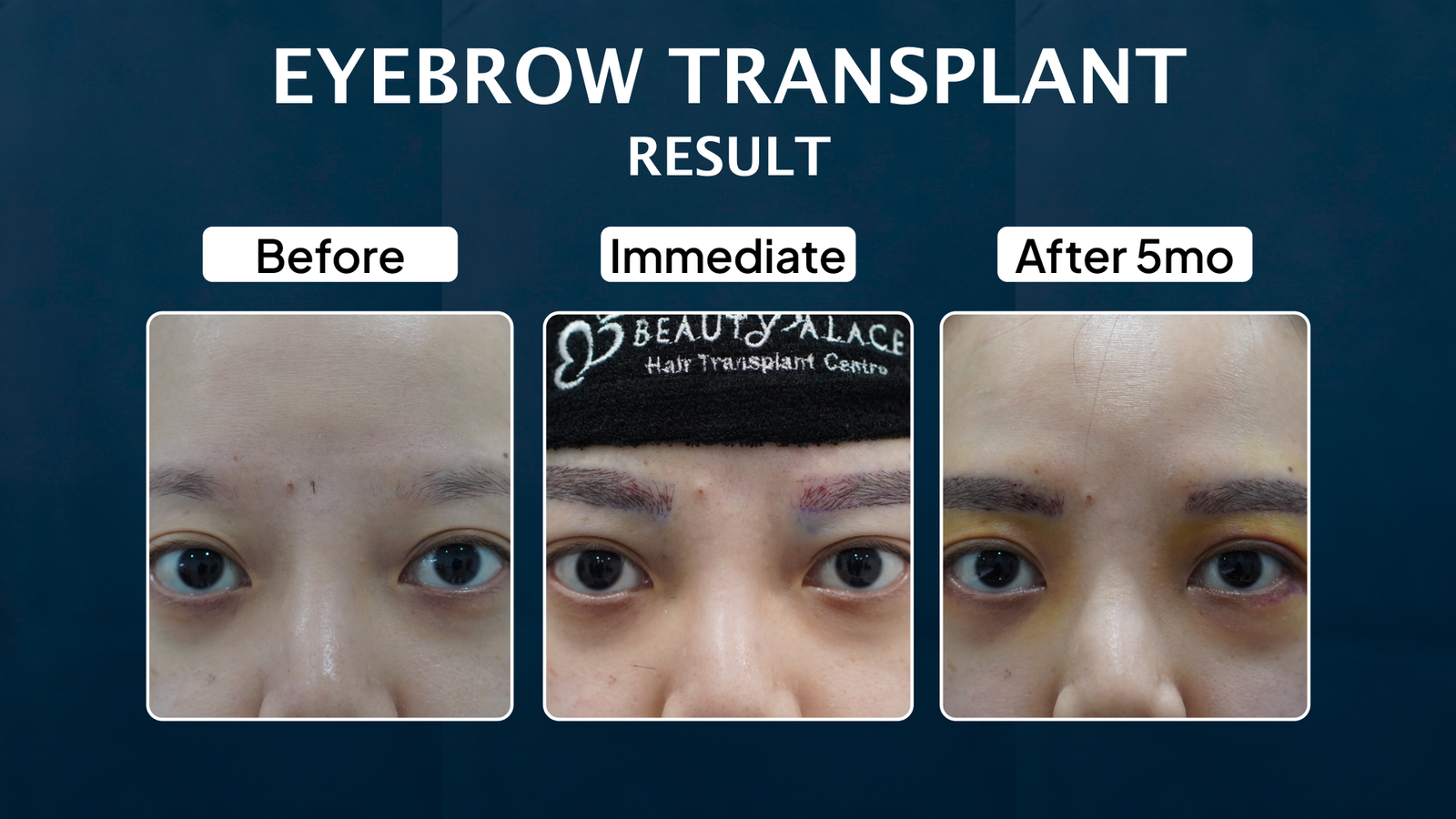 Journey Eyebrow 5mth